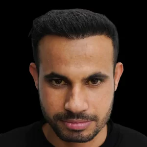 hair transplant after