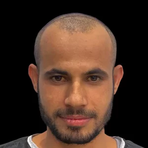 hair transplant before