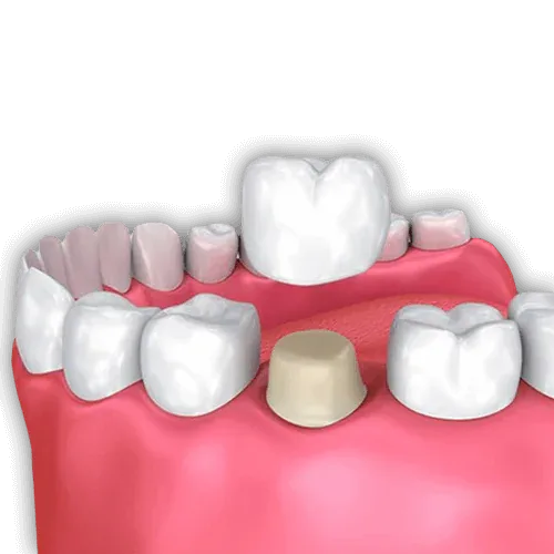 Advantages of Dental Crowns