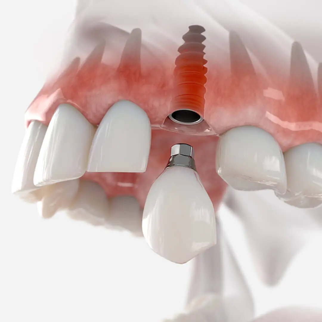 Advantages of Dental Implants