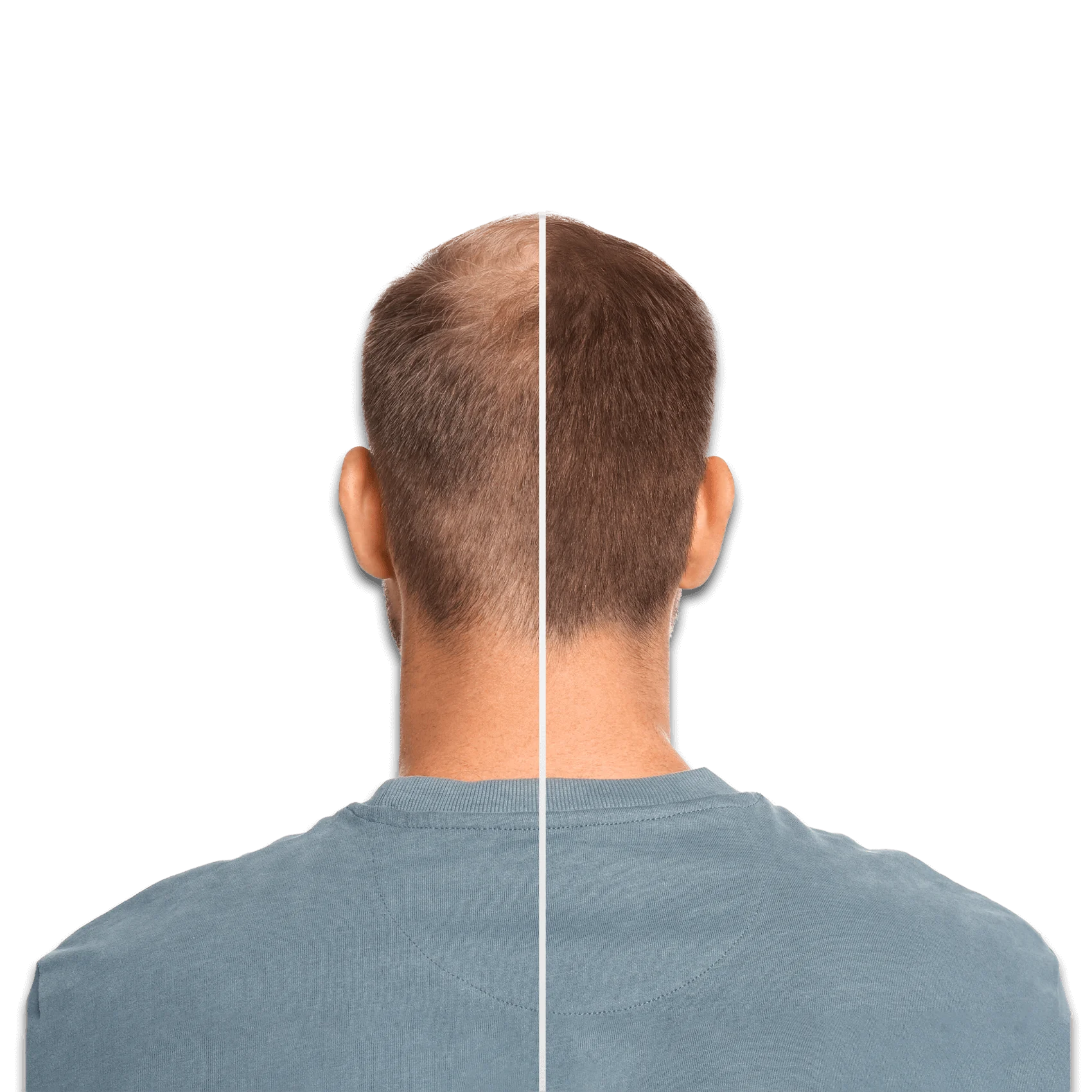 Advantages of Hair Transplant