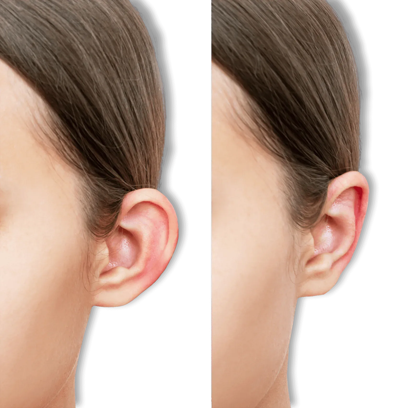 Advantages of Otoplasty