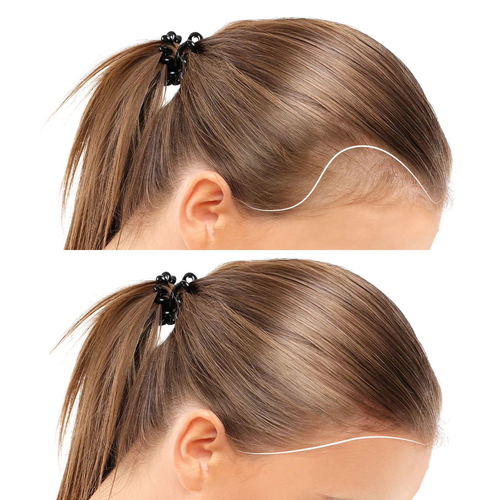 Advantages of Woman Hair Transplant