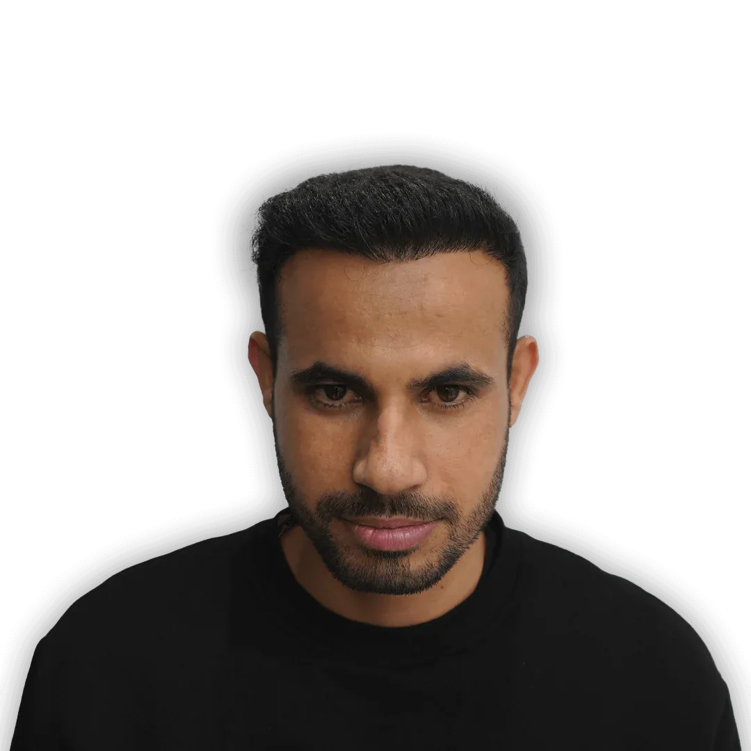 After Hair Transplant Surgery
