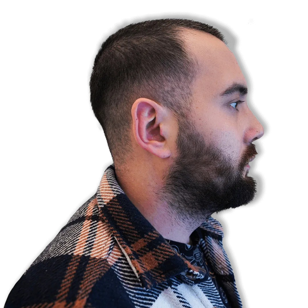 After Rhinoplasty Surgery
