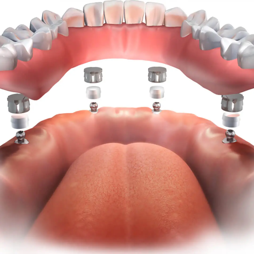 All On Four Implant In One Day