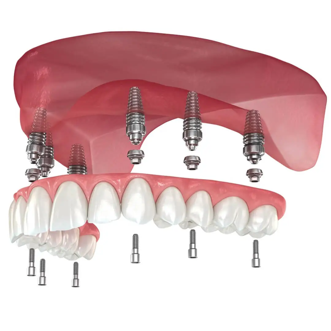 All On Six Implant
