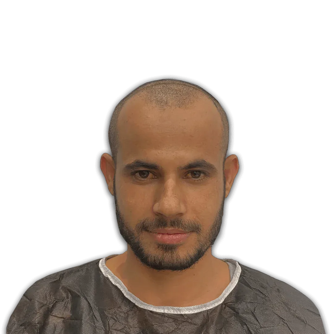 Before Hair Transplant Surgery