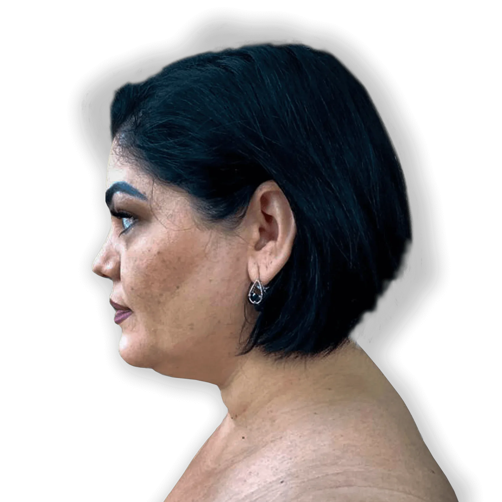 Before Neck Liposuction Surgery