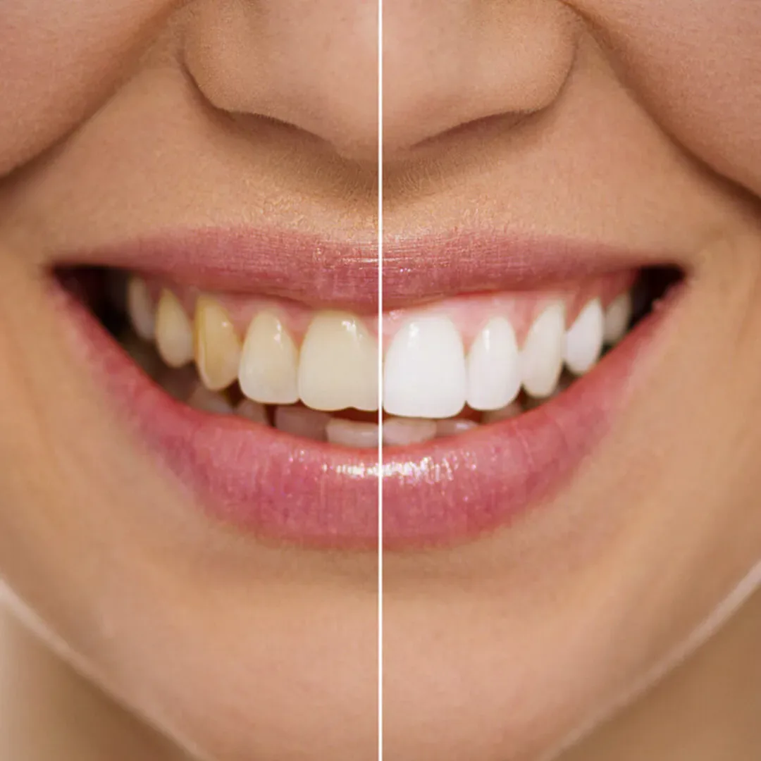Bleaching (Laser And Home Kit)