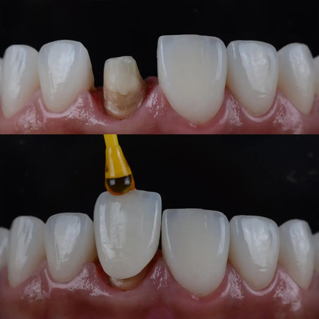 Crowns