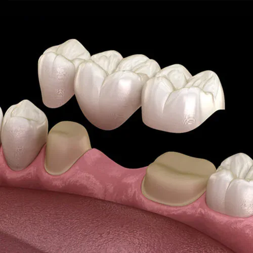 Dental Bridges