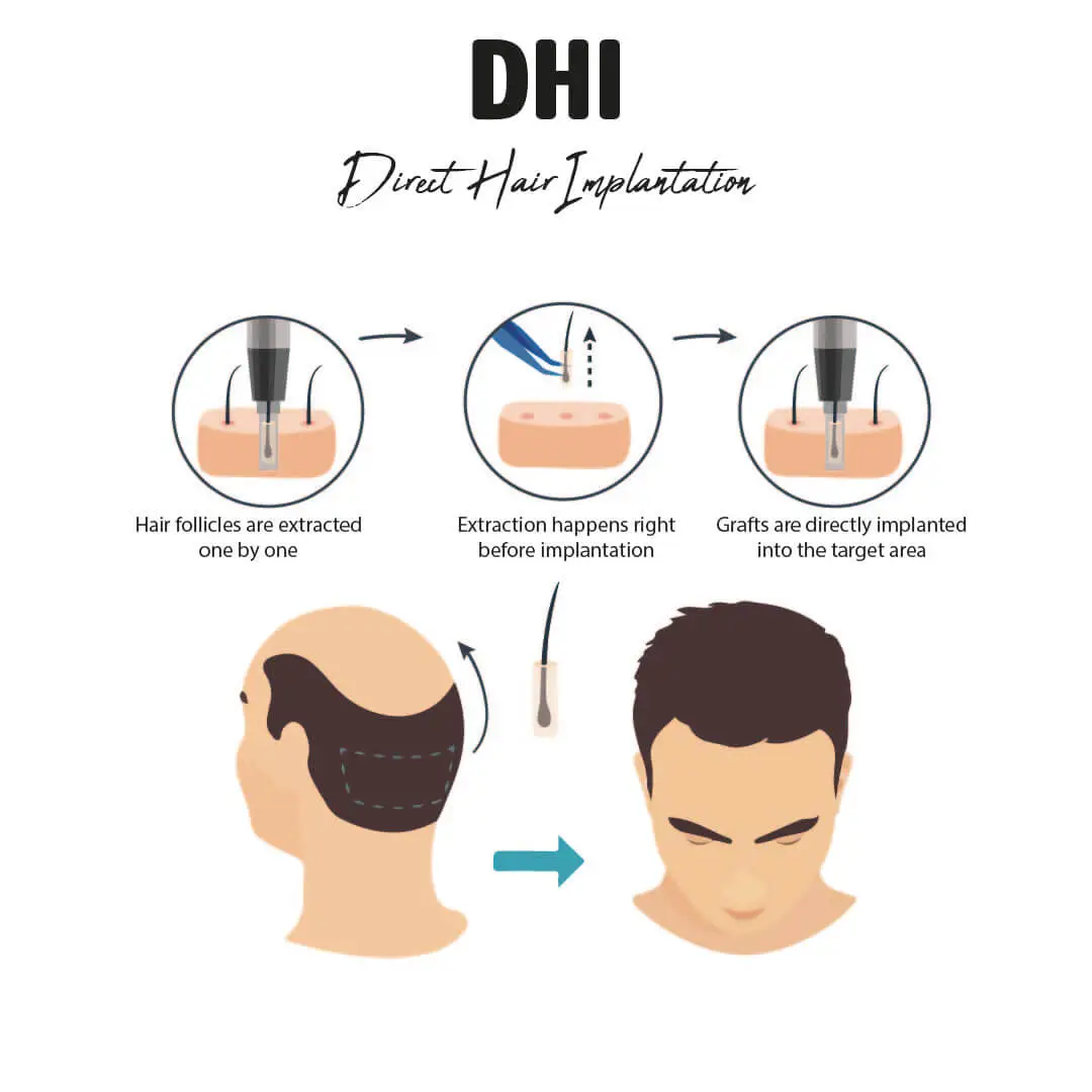 Dhi technique