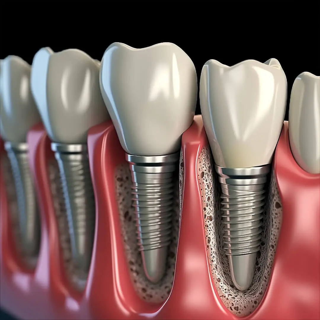 Implant Surgery