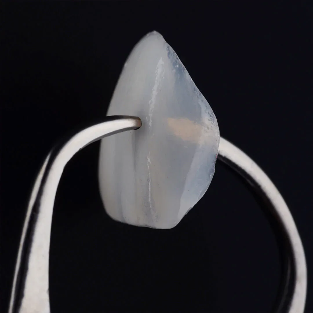 Veneers (Lumineer)