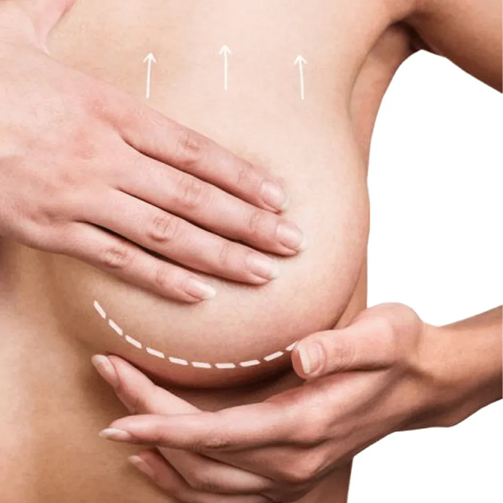 What Are Breast Lift