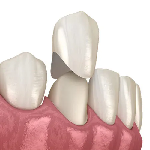 What Are Dental Crowns