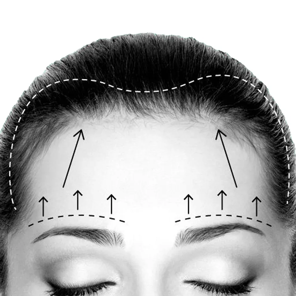 What Are Eyebrow Lift