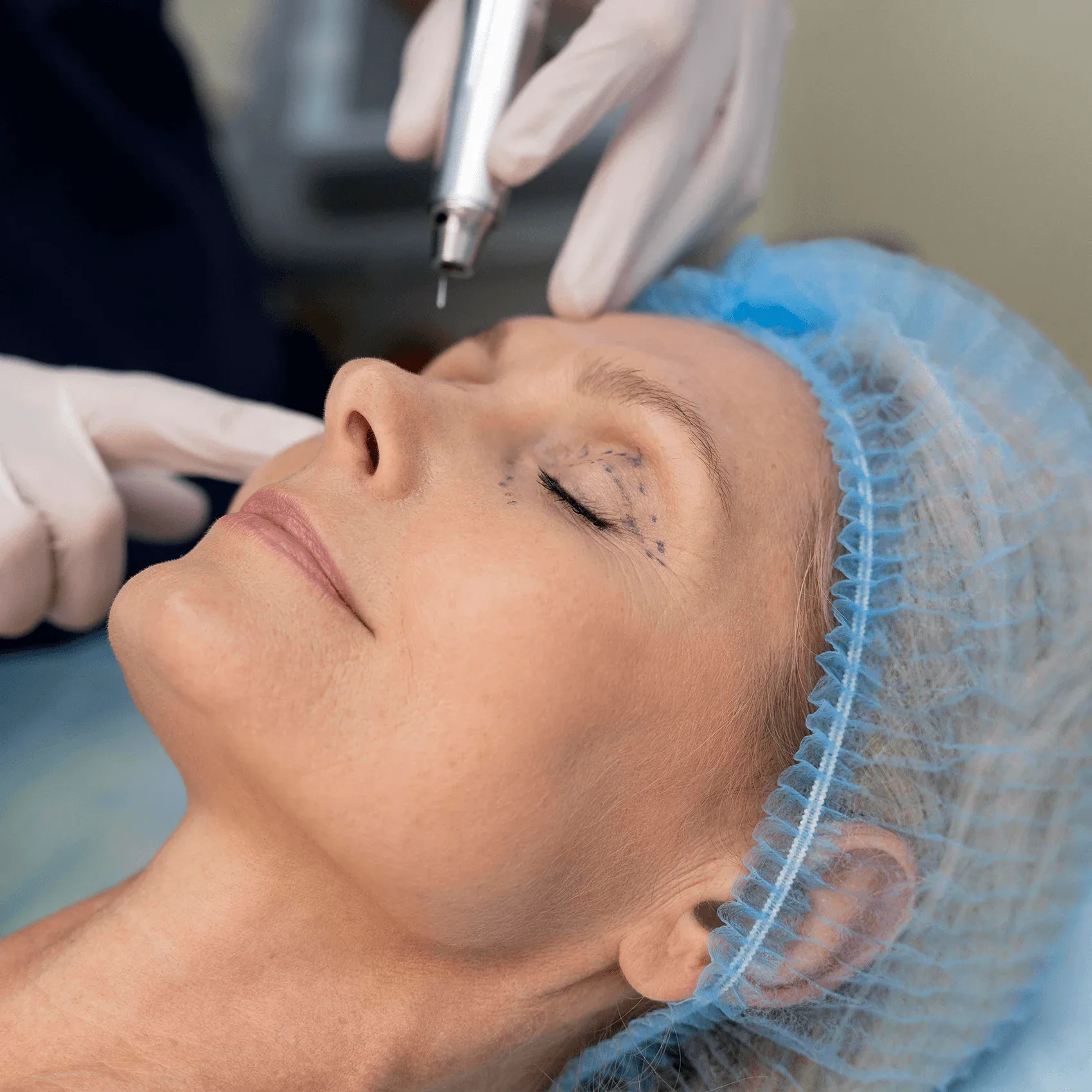 Why Choose Us for Eyelid Surgery Treatment in Istanbul, Turkey