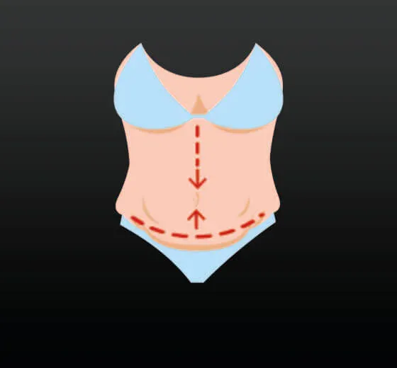 Abdominoplasty ( Tummy Tuck )