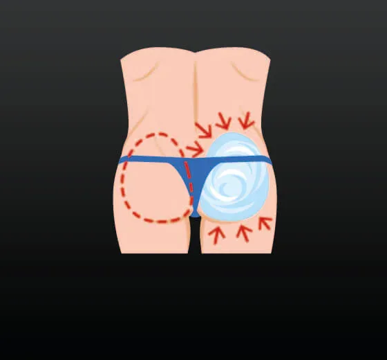 Brazilian Butt Lift (BBL)