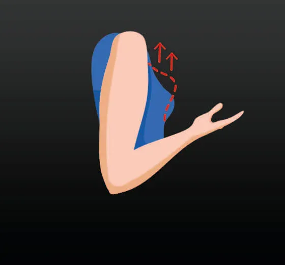 Breast Lift