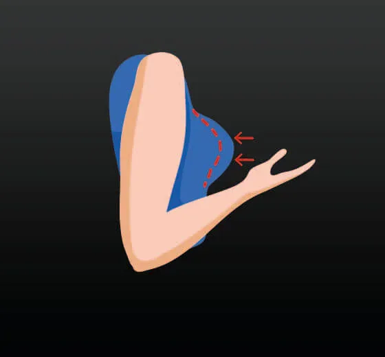 Breast Reduction