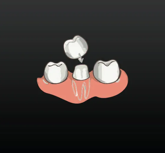 Dental Crowns