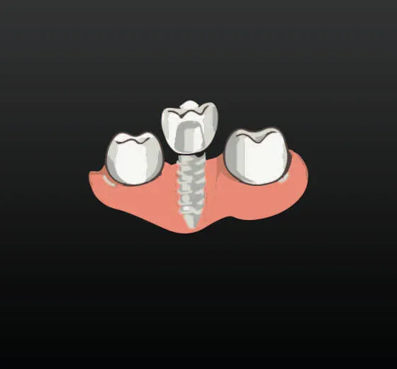 Dental Implant