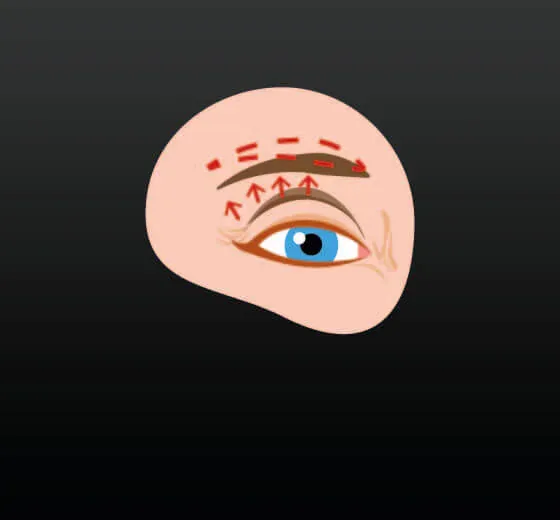 Eyebrow Lift