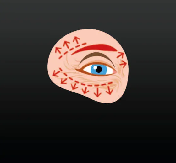 Blepharoplasty