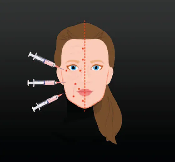 Face Fat Injection