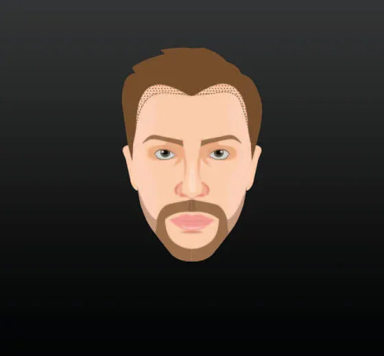 Hair Transplant