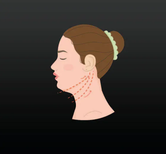 Neck Lifting