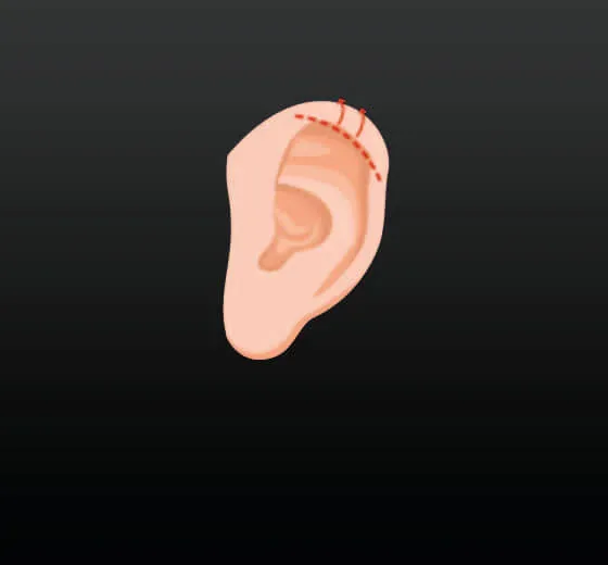 Otoplasty
