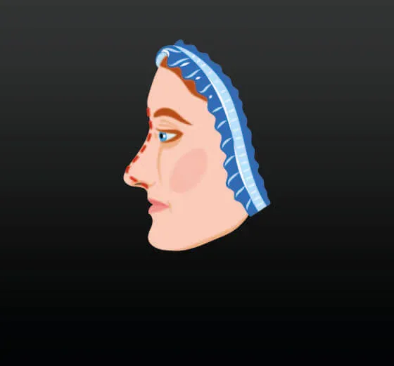 Rhinoplasty