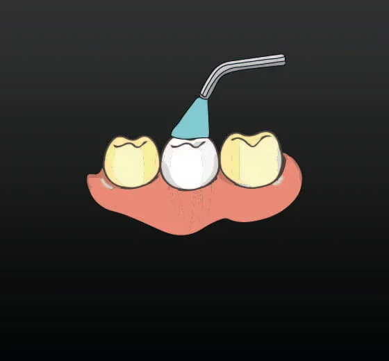Teeth Whitening