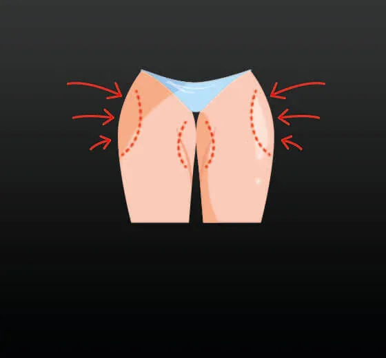 Inner Thigh Lifting