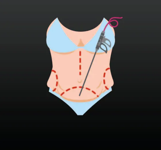 Vaser Liposuction