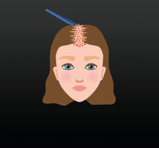 Woman Hair Transplant