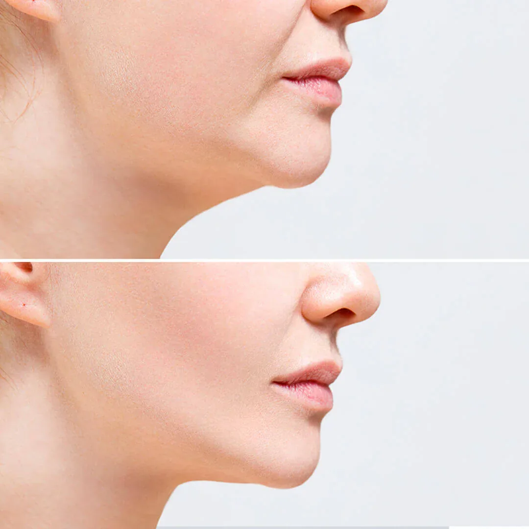 Advantages of Chin Beautification Surgery