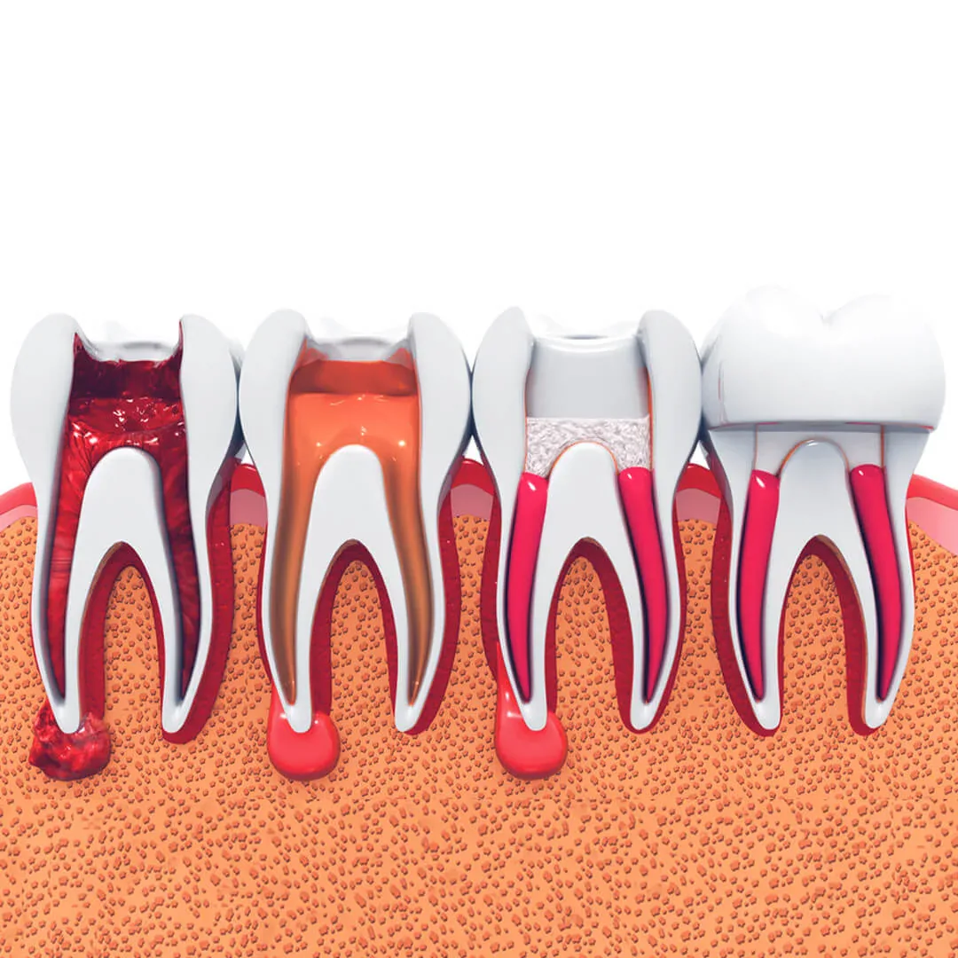 Advantages of Endodontics Advantages of Endodontics