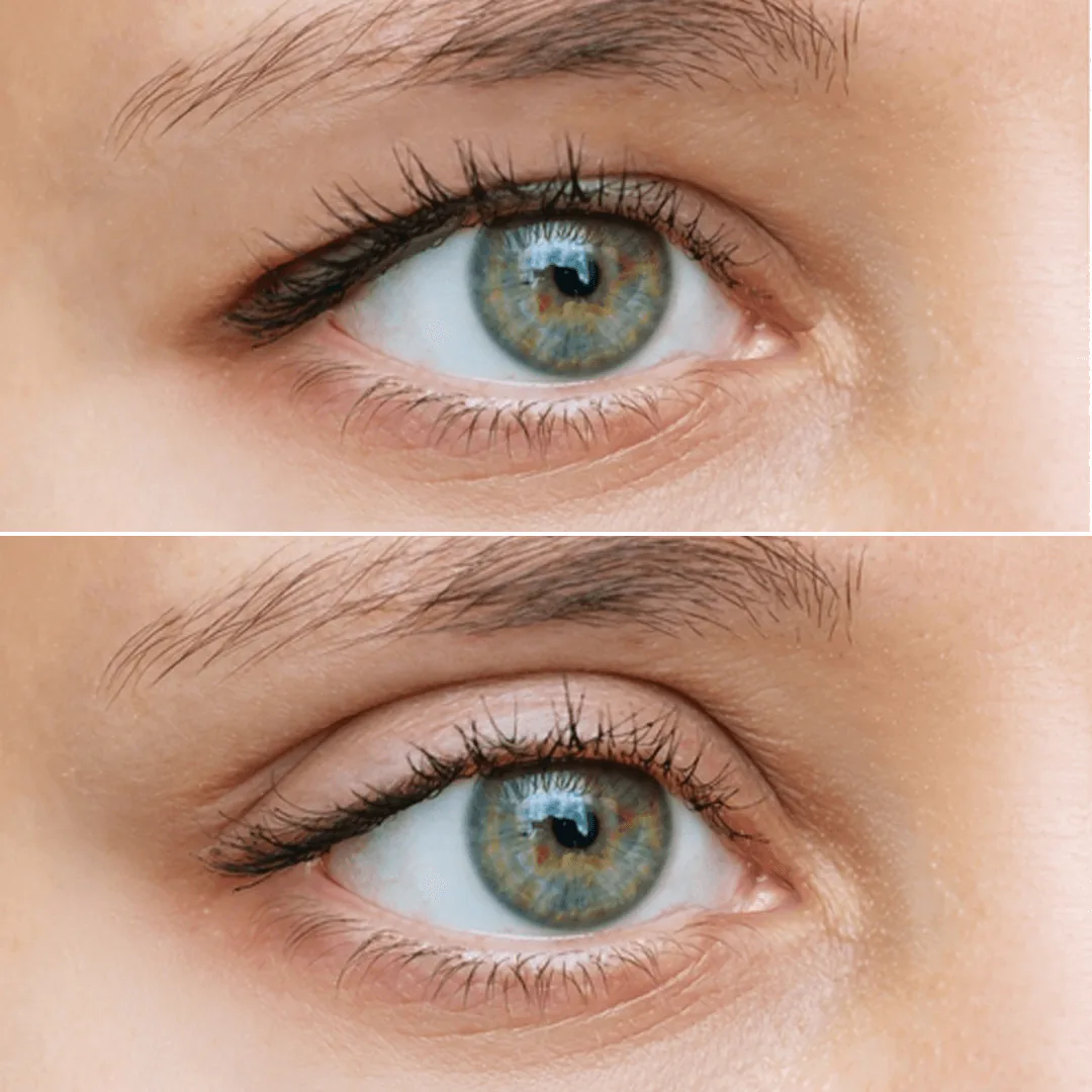 Advantages of Eyelid Surgery