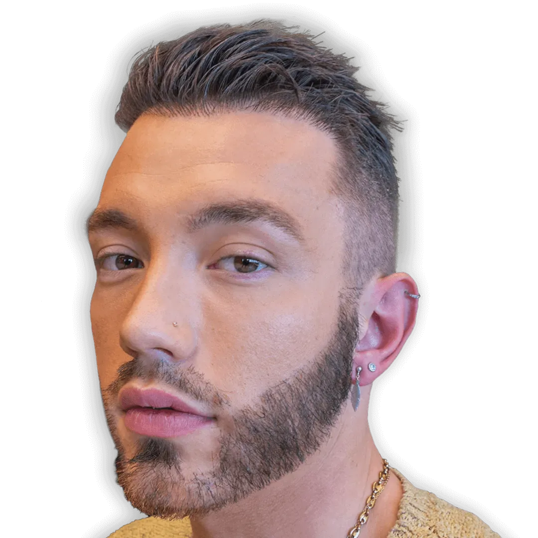 After Beard Transplant Surgery