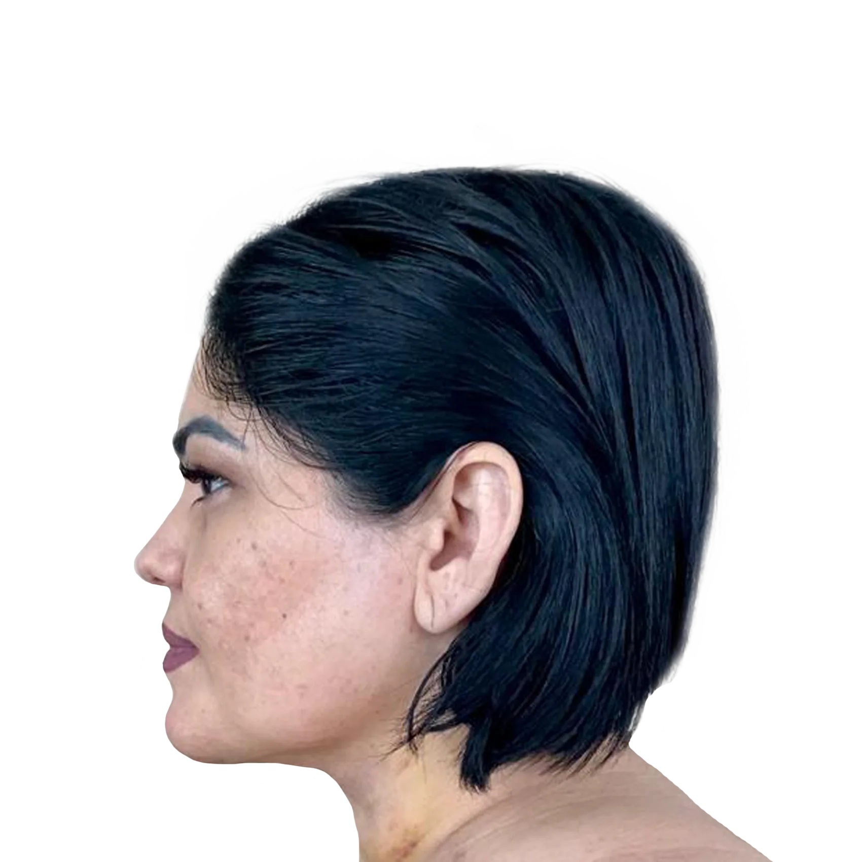 After Neck Liposuction Surgery