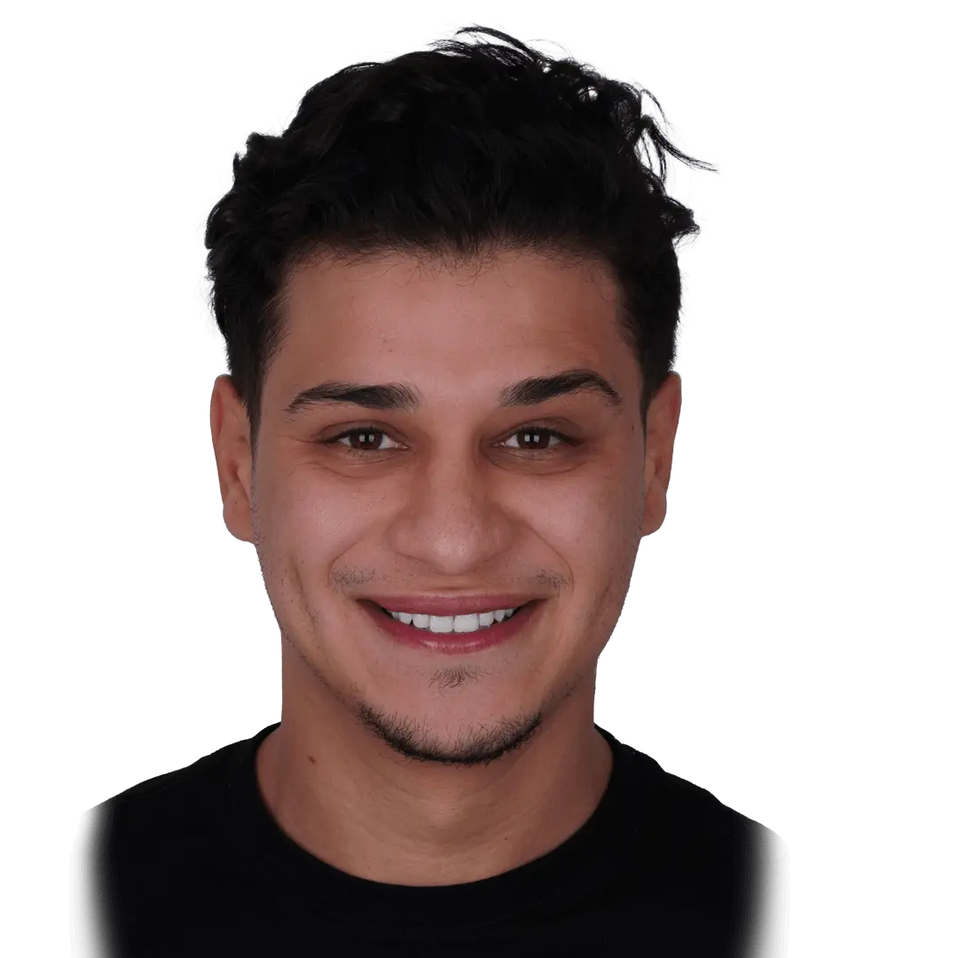 After Teeth Whitening Treatment