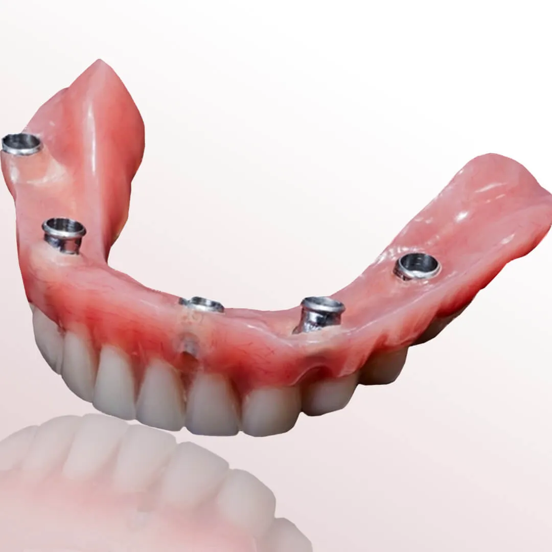 All On Five Implant