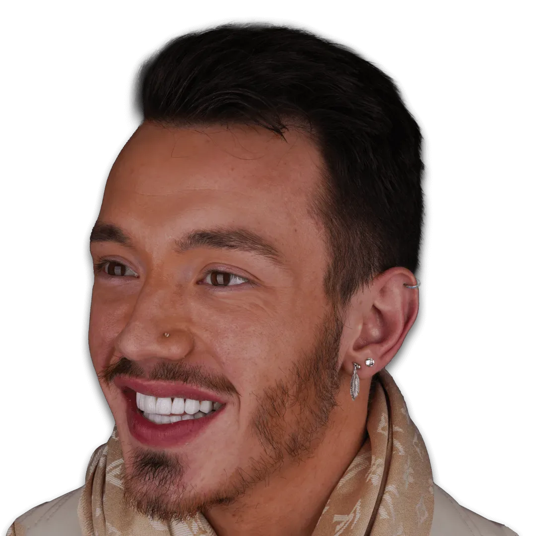 Before Beard Transplant Surgery