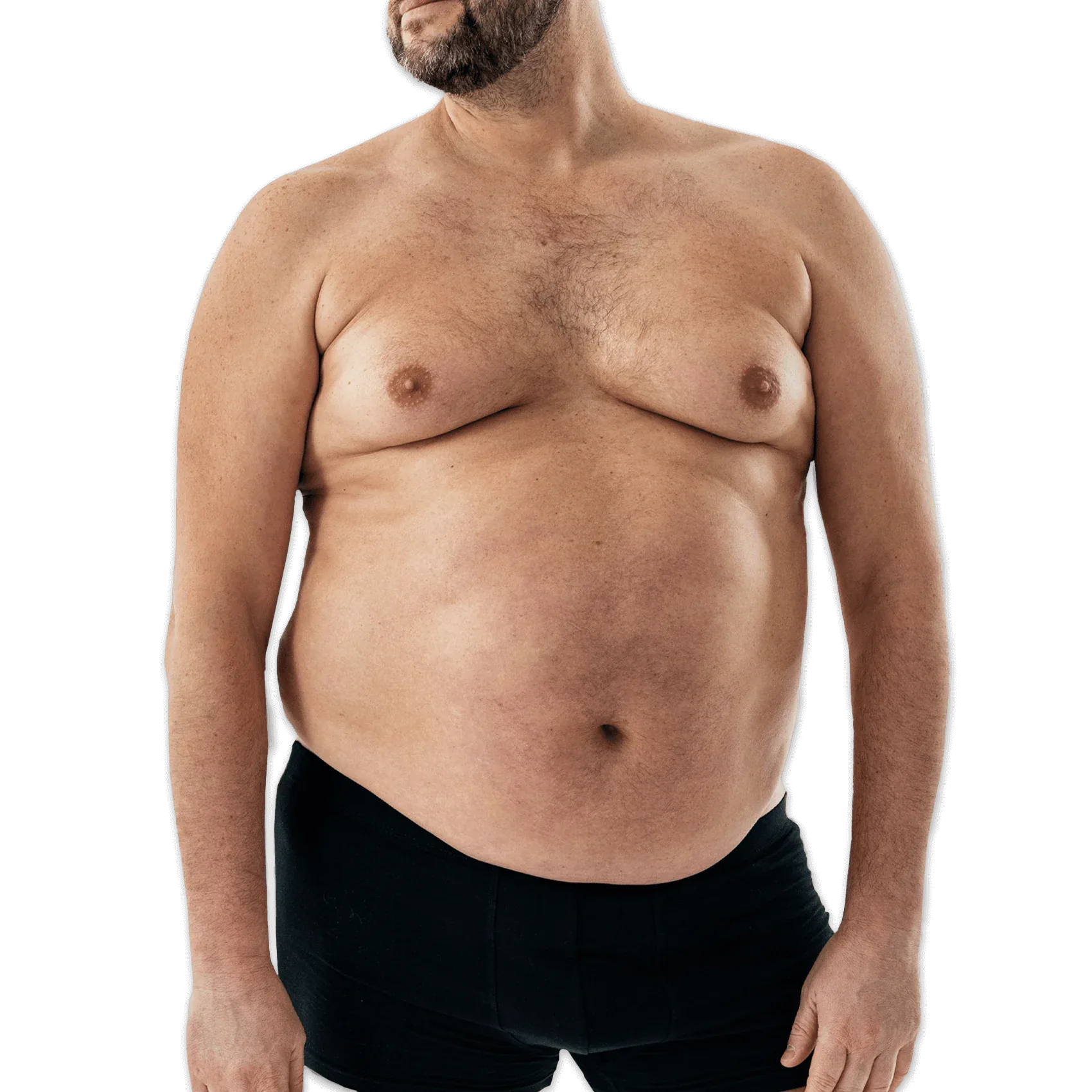 Before Gynecomastia Surgery