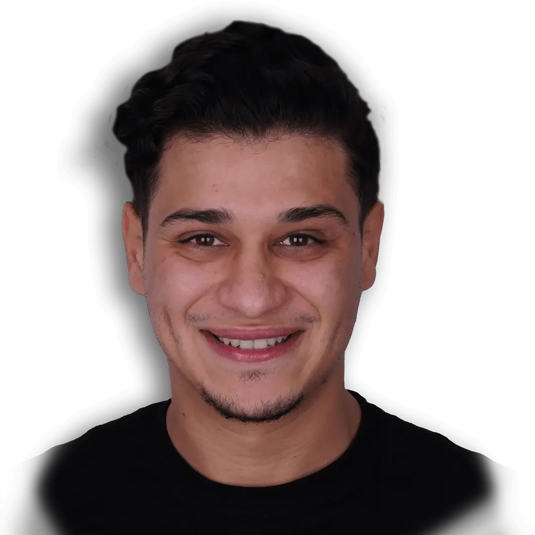 Before Teeth Whitening Treatment